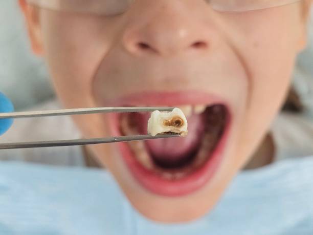Best Dentist for Tooth Abscess  in Fond Du Lac, WI